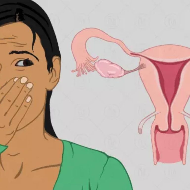 درمان بوی بد واژن