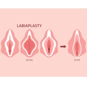 عمل لابیاپلاستی در مشهد