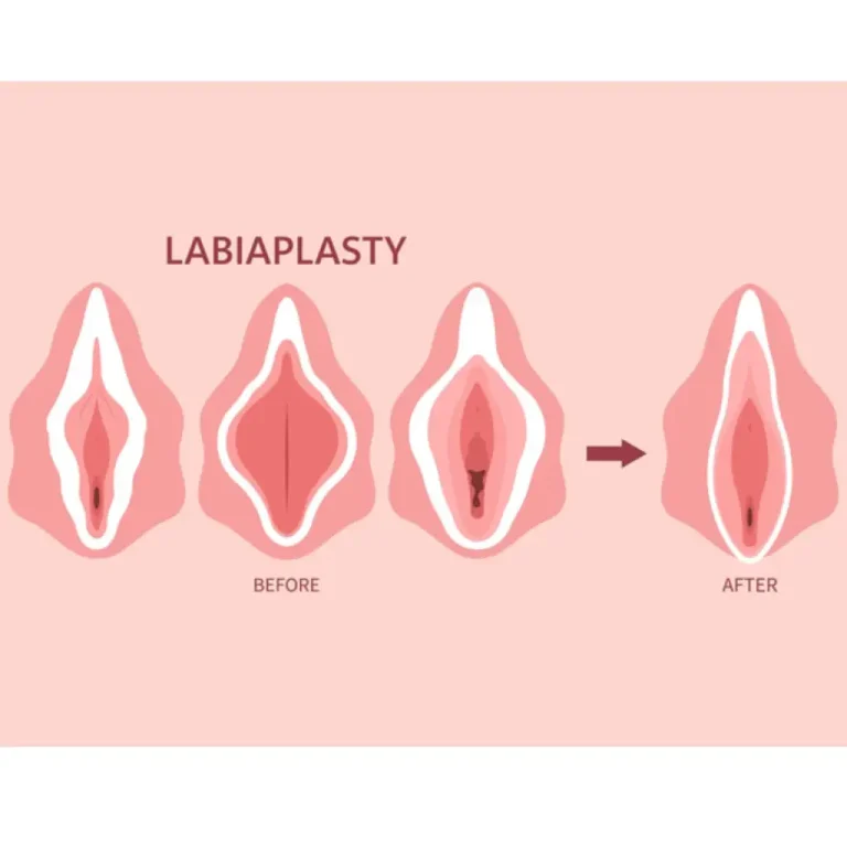 عمل لابیاپلاستی در مشهد