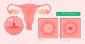 Cervical and vaginal infection