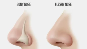 مقایسه ضخامت پوست در جراحی بینی استخوانی و گوشتی