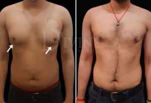 نتیجه عمل کوچک کردن سینه مردان
