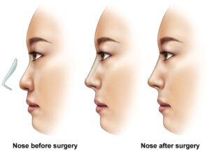 عمل جراحی بینی در مشهد