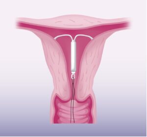 قرار دادن آی دی یو IDU در مشهد