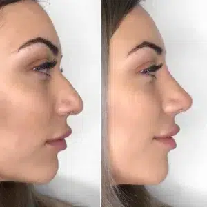 فیلر بینی در مشهد