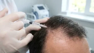 عکس پی آر پی مو در مشهد برای تقویت فولیکول و کاهش ریزش