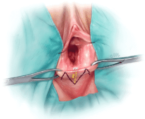 آناتومی ناحیه پرینه و نحوه عمل پرینورافی[Image of female perineum anatomy]
