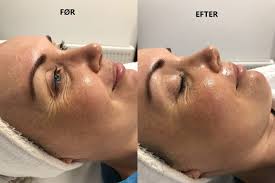 درما اکسی در مشهد