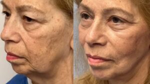 فیس لیفت در مشهد