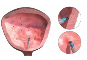 درمان واژینستون با بوتاکس در مشهد