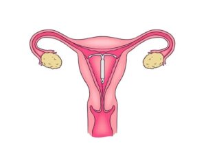 قرار دادن آی دی یو IDU در مشهد