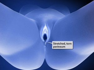 نتیجه عمل پرینورافی و تنگ کردن دهانه واژن