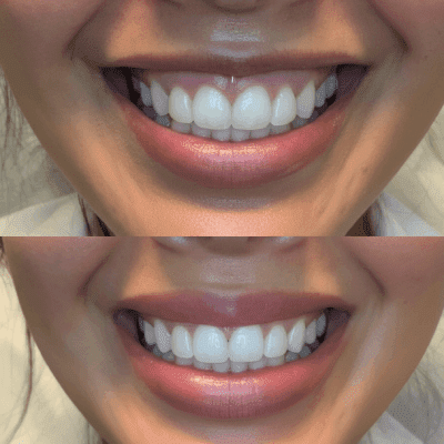 عکس مقایسه‌ای قبل و بعد از جراحی لیفت سانترال لب