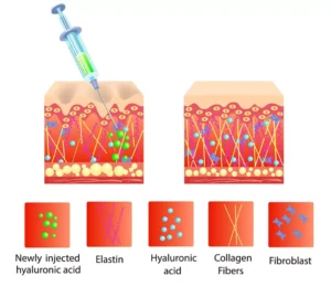 تزریق پروفایلو در مشهد