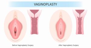 واژینوپلاستی