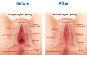 واژینوپلاستی