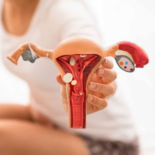 بررسی بهترین روش‌های درمانی اندومتریوز (4 مورد)