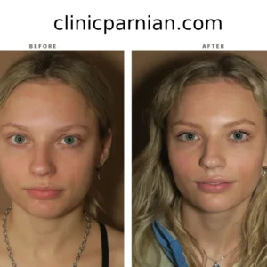 بوکال فت صورت در مشهد