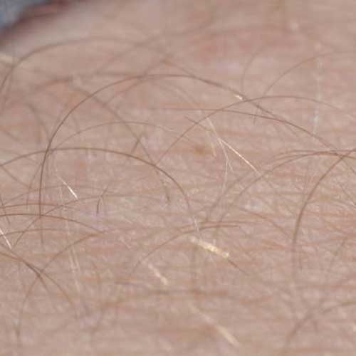 دلایل اصلی پر مویی در زنان