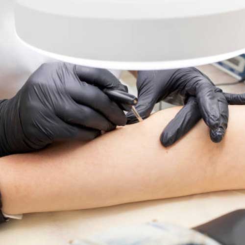 درمان پرمویی با لیزر