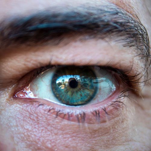 علت افتادگی پلک + عوارض خطرناک اگر عمل جراحی انجام نشود