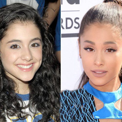 معروف ترین سلبریتی های جهانی که عمل زیبایی انجام داده اند