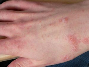 بیماری گال پوستی چیست و چه علائمی دارد؟