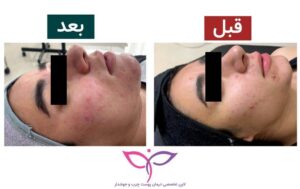 فیشیال تخصصی برای درمان جوشهای کیستی