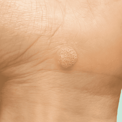 جلسه مشاوره محرمانه و تخصصی برای درمان HPV و زگیل تناسلی در کلینیک پرنیان مشهد.