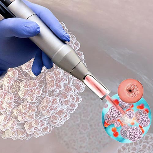 دستگاه پیشرفته لیزر در کلینیک پرنیان برای درمان قطعی زگیل تناسلی (HPV).