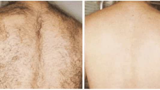 تصویر قبل و بعد لیزر بدن آقایان (پشت) در کلینیک زیبایی