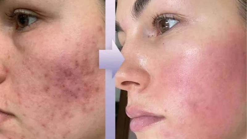 تاثیر میکرونیدلینگ بر درمان جای جوش قبل و بعد