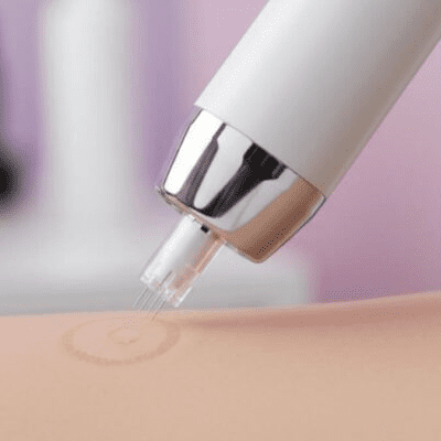 میکرونیدلینگ صورت در کلینیک زیبایی پرنیان