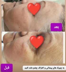 فیشیال صورت پلاژن تراپی با هدف جوانسازی 