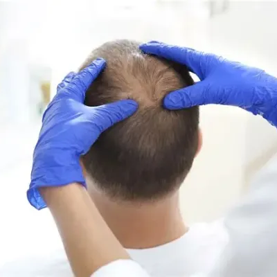 کاشت مو به روش میکروگرافت در مشهد