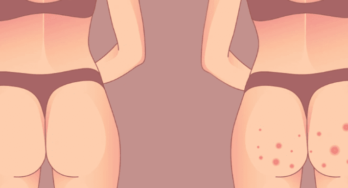 تصویر قبل و بعد از لیزر جای جوش باسن در کلینیک پرنیان