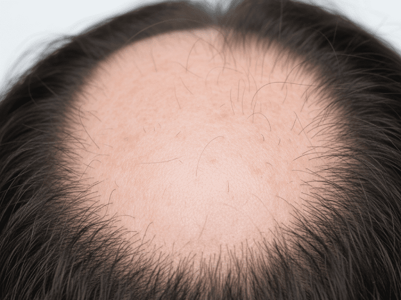 نمونه نزدیک از یک لکه ریزش موی سکه‌ای (آلوپسی آره آتا) روی پوست سر