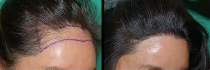 نمونه قبل و بعد لیزر موی پیشانی و طراحی خط رویش در مشهد
