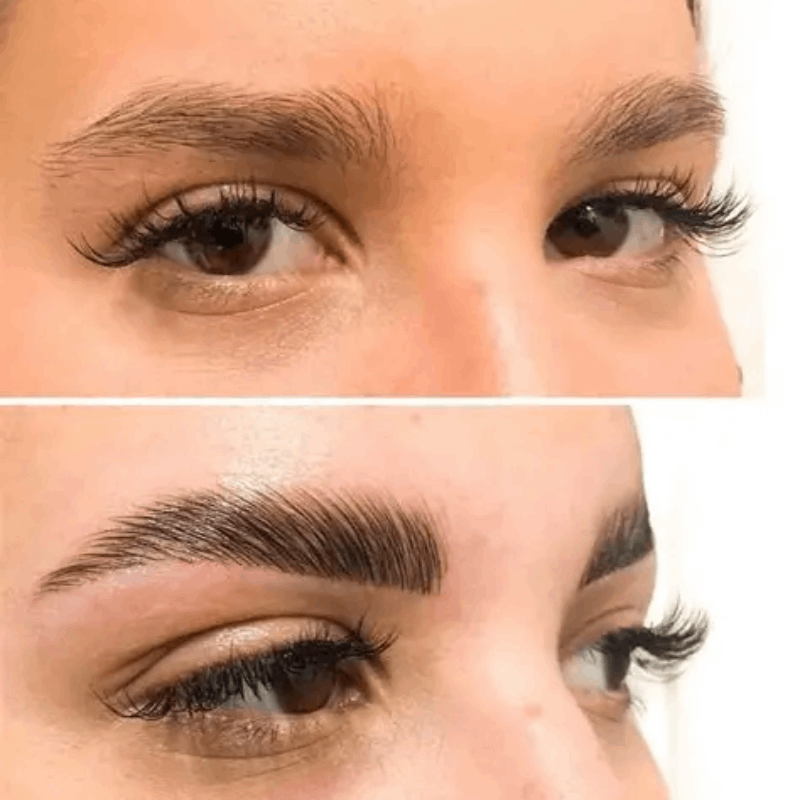 عکس قبل و بعد مزوتراپی ابرو در مشهد کلینیک پرنیان