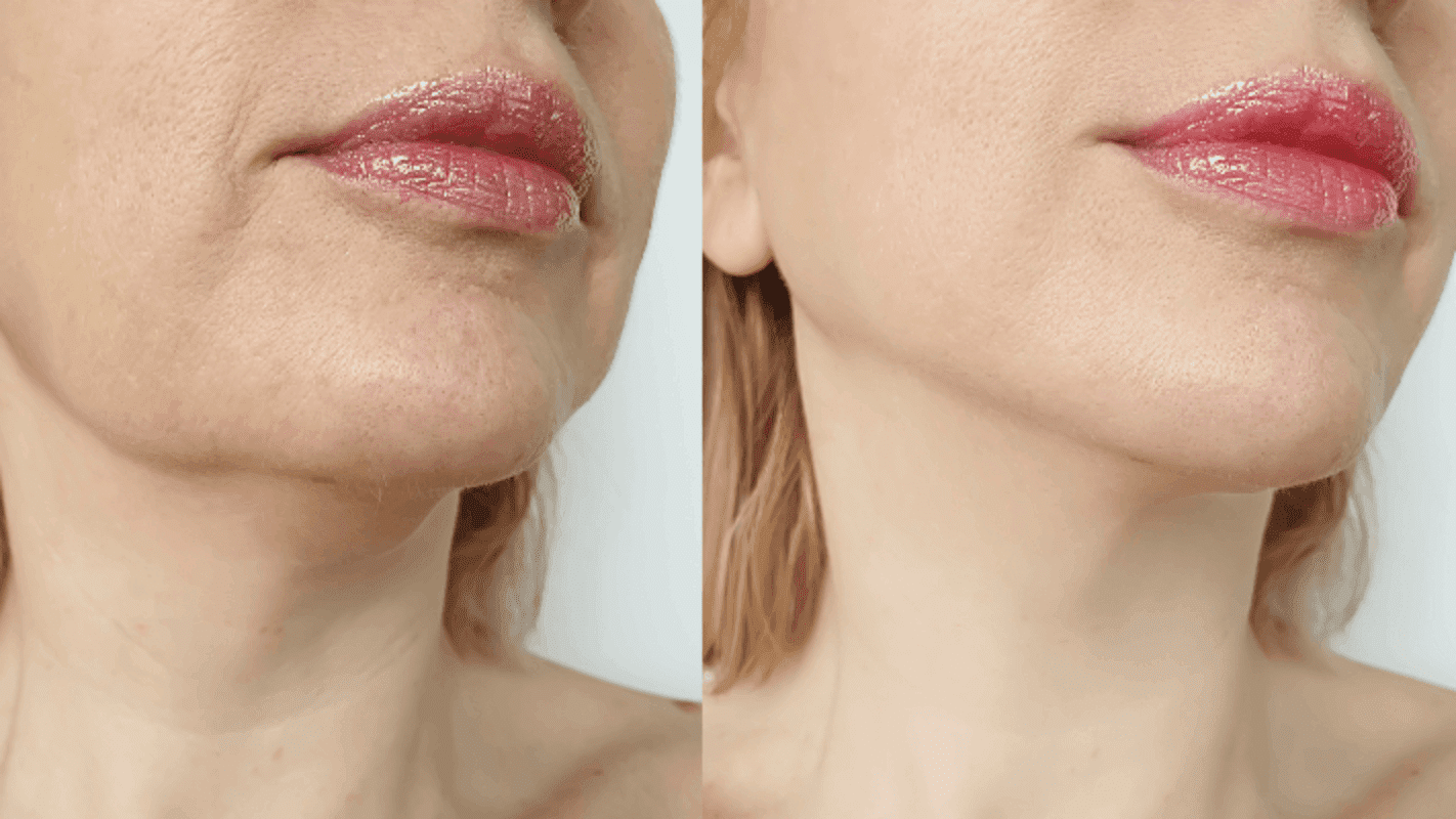 مقایسه قبل و بعد از تزریق پروفایلو: بهبود چشمگیر کیفیت و سفتی پوست