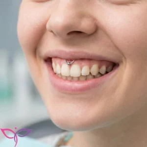 انجام تخصصی پیرسینگ اسمایل (لبخند) در کلینیک پرنیان مشهد با نگین ظریف و بدون آسیب به دندان.