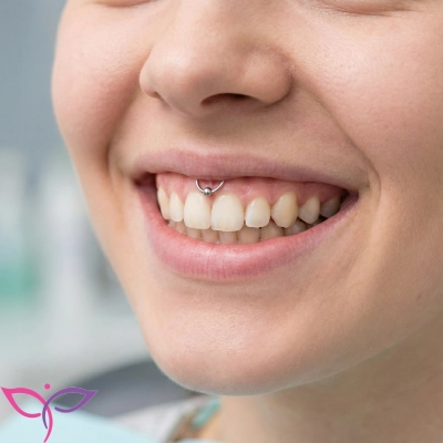 انجام تخصصی پیرسینگ اسمایل در مشهد با نگین استاندارد