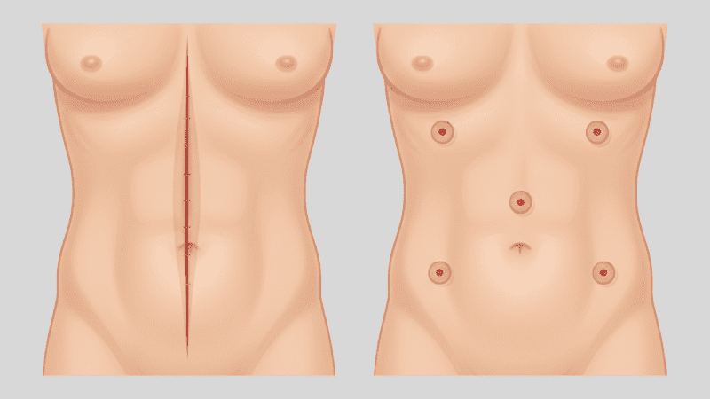مقایسه جراحی افتادگی رحم با لاپاراسکوپی (برش کوچک) با جراحی باز (برش بزرگ)