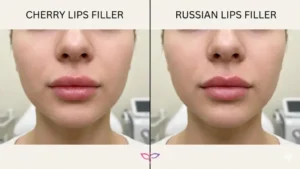 مقایسه تصویری مدل ژل لب گیلاسی و مدل روسی از نظر فرم، حجم و پروفایل لب