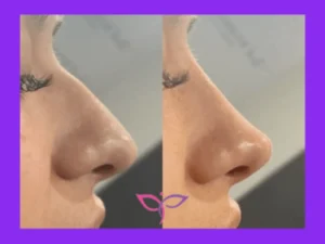 عکس قبل و بعد اصلاح بینی با فیلر