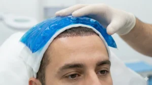 نحوه صحیح کمپرس سرد برای درمان ورم بعد از کاشت مو