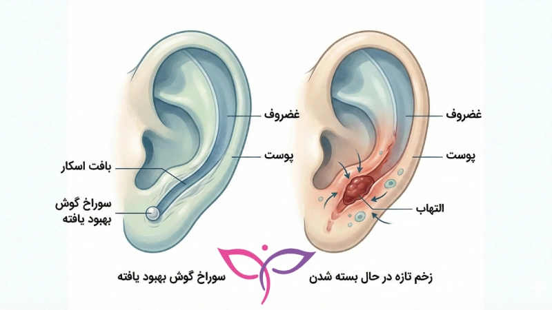مدت زمان بسته شدن سوراخ گوش در نرمه و غضروف با تصویر شماتیک