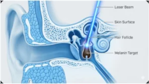 نمایش علمی و تخصصی عملکرد لیزر بر روی فولیکول مو در ناحیه حساس (گوش یا بینی) و مکانیسم "فوتوترمولیز انتخابی".