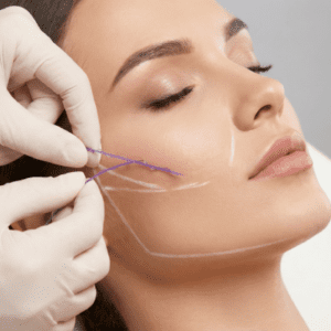 مشاوره قیمت لیفت صورت با نخ در سال ۱۴۰۴ برای بانوی میانسال در کلینیک زیبایی پرنیان