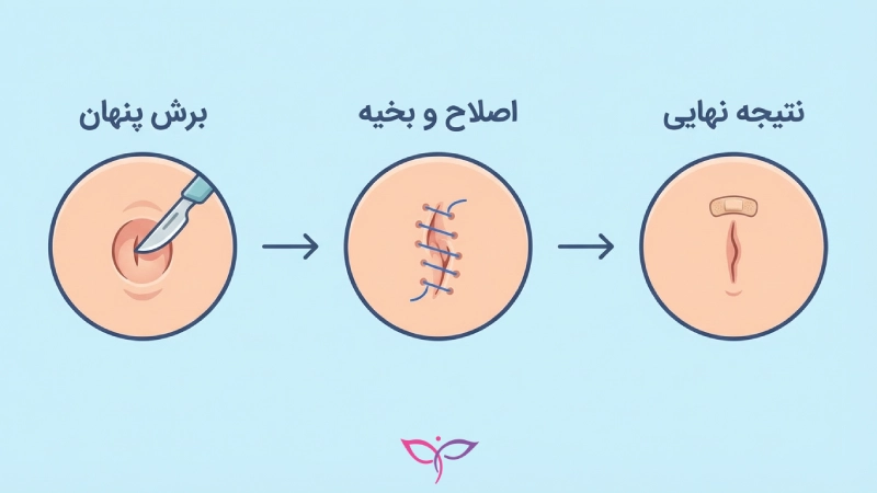 تصویرسازی مراحل انجام جراحی زیبایی ناف (امبیلیکوپلاستی) که سه مرحله اصلی شامل برش پنهان در داخل ناف، اصلاح فرم و بخیه زدن، و نتیجه نهایی و ظریف عمل را نشان می‌دهد